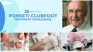 Correcting Clubfoot The Ponseti Method in English accent from USA [upl. by Comras882]