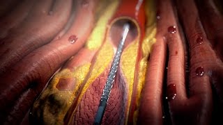 Stent Procedure [upl. by Esmerolda314]