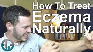 How To Treat Eczema Naturally [upl. by Mendoza]