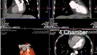 Coronary CT Angiography RCA Stenosis [upl. by Ardnuaek]