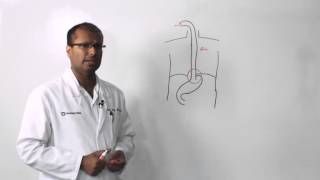 Understanding Esophageal Cancer [upl. by Ayrb927]