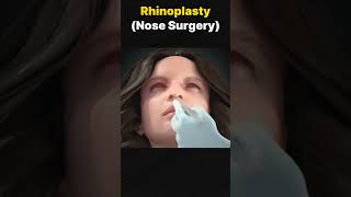 Rhinoplasty [upl. by Ainoloppa579]