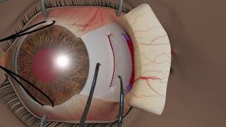 Strabismus surgery Recession [upl. by Sicnarf]