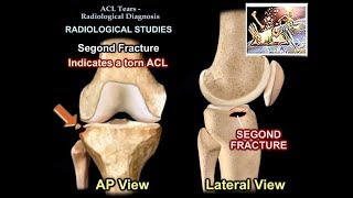 ACL Tears Radiological Evaluation  Everything You Need To Know  Dr Nabil Ebraheim [upl. by Wallraff517]