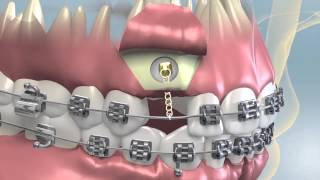 Impacted Tooth Exposure amp Uncovering For Orthodontics [upl. by Wasserman]