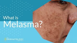 What is Melasma  Melasma Treatment Explained [upl. by Ornstead]