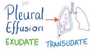 Pleural Effusion  Transudate or Exudate  Causes and Liddle’s Criteria Pulmonary Medicine Playlist [upl. by Attela]