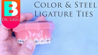 BRACES EXPLAINED Color and Steel Ligature Ties [upl. by Adniled]