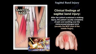 Sagittal Band Injury  Everything You Need To Know  Dr Nabil Ebraheim [upl. by Clyde]