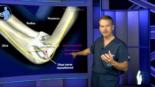 Cubital Tunnel Surgery [upl. by Najtsirk]