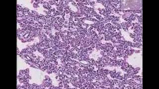 Histopathology LungHyaline membrane disease [upl. by Ainevuol]