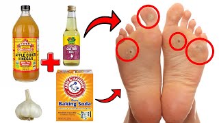 14 Proven Home Remedies For Corns amp Callus Removal THAT WORK [upl. by Sudnak985]