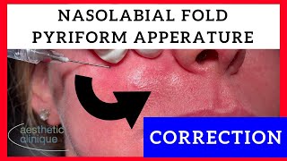 Pyriform Apperature  Nasolabial Folds Correction by Dr Steven Weiner [upl. by Limoli]