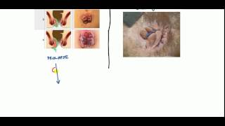 Hemorrhoids Lecture for USMLE [upl. by Einavoj]