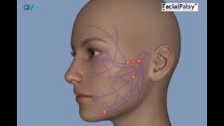 Understanding Facial Palsy [upl. by Asil]