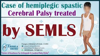 Hemiplegic Spastic CPwmv [upl. by Eli]