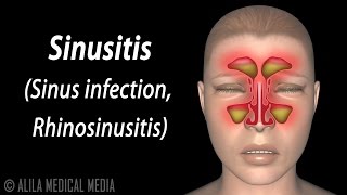 Sinusitis Animation [upl. by Nodanrb111]