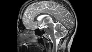 The Visual Pathway Neuroanatomy Video Lab  Brain Dissections [upl. by Adnovay]